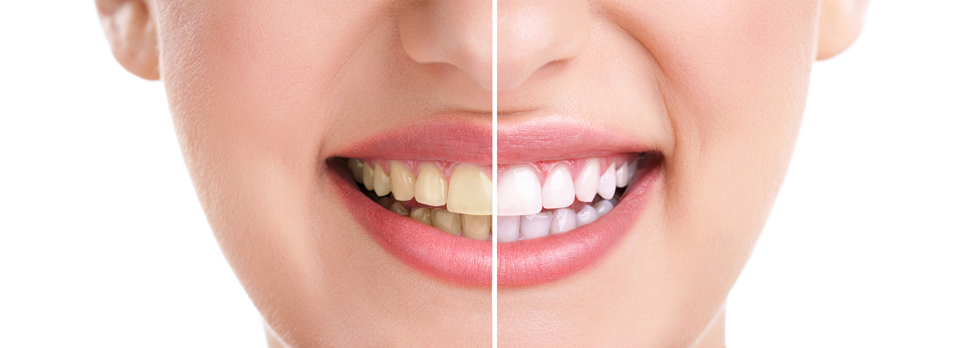 Teeth Whitening in Simi Valley